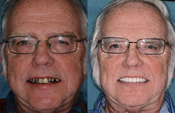 HZA™ --🦷Advanced Customized Full Denture Set🦷 {Developed by Harvard University}