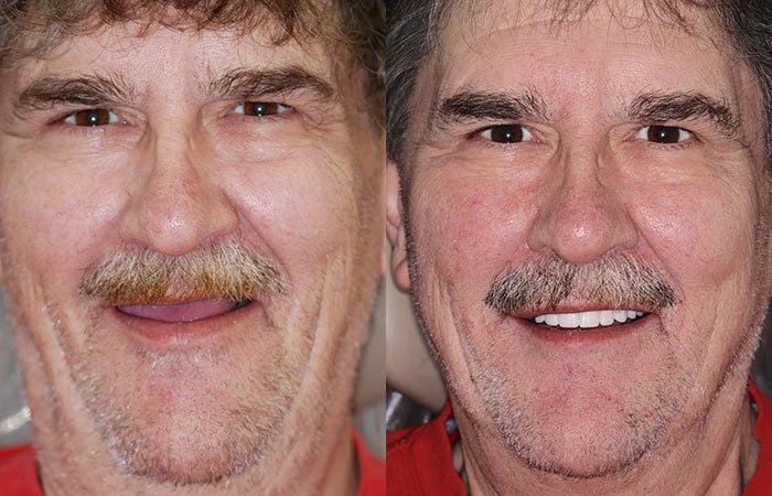 HZA™ --🦷Advanced Customized Full Denture Set🦷 {Developed by Harvard University}