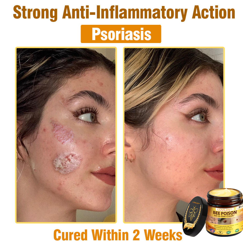 LOVILDS™ Bee Poison All-in-One Cream US Dermatologist Approved