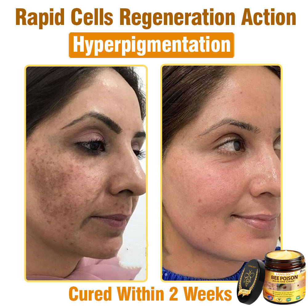 LOVILDS™ Bee Poison All-in-One Cream US Dermatologist Approved