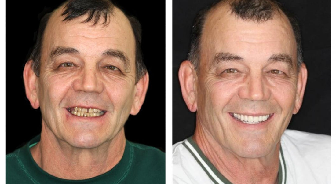 HZA™ --🦷Advanced Customized Full Denture Set🦷 {Developed by Harvard University}
