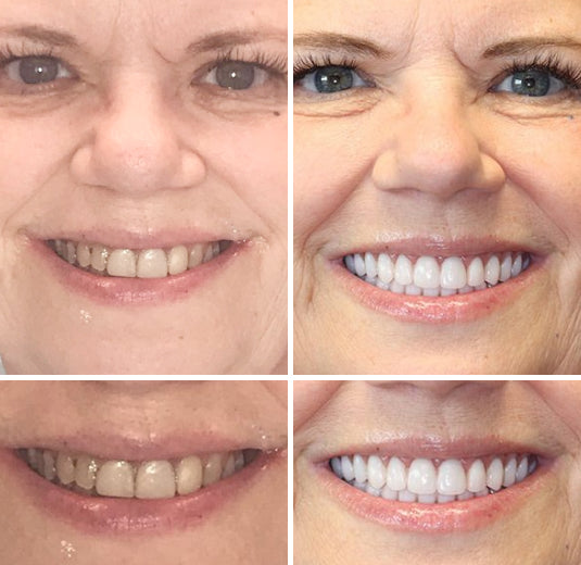 HZA™ --🦷Advanced Customized Full Denture Set🦷 {Developed by Harvard University}