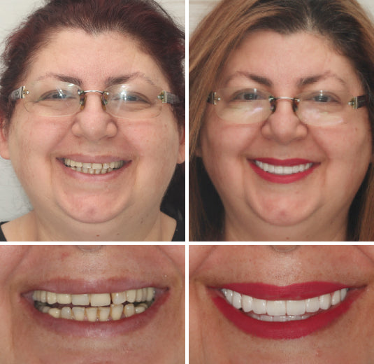 HZA™ --🦷Advanced Customized Full Denture Set🦷 {Developed by Harvard University}
