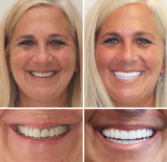 HZA™ --🦷Advanced Customized Full Denture Set🦷 {Developed by Harvard University}