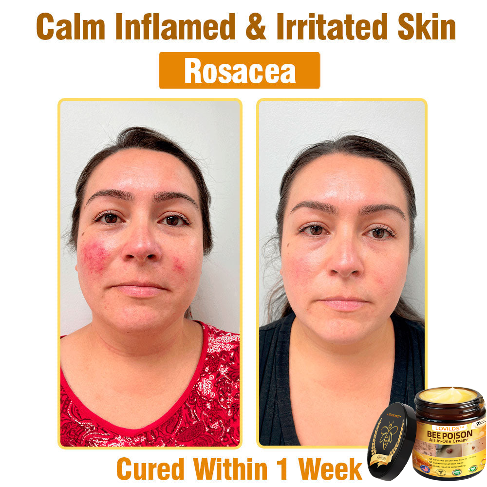 LOVILDS™ Bee Poison All-in-One Cream US Dermatologist Approved