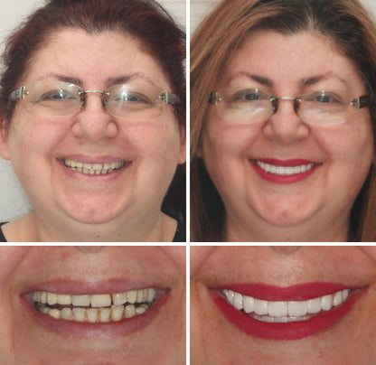 HZA™ --🦷Advanced Customized Full Denture Set🦷 {Developed by Harvard University}