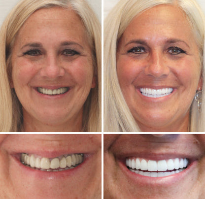 HZA™ --🦷Advanced Customized Full Denture Set🦷 {Developed by Harvard University}